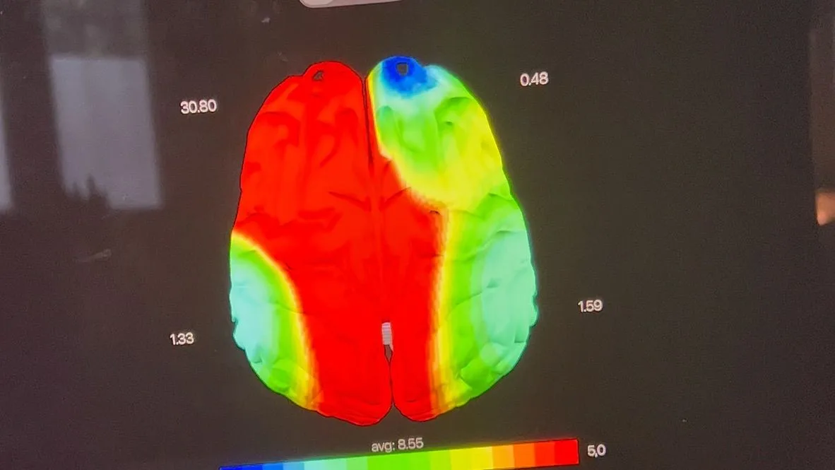 Mappa dell'attività cerebrale